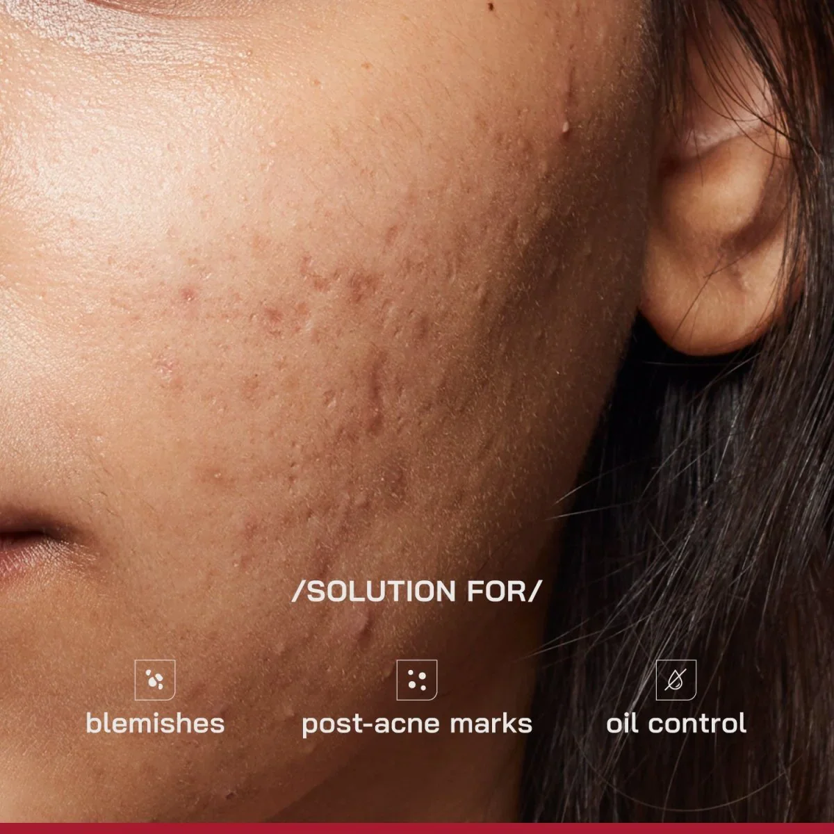 Acne Pro Serum - Image 4