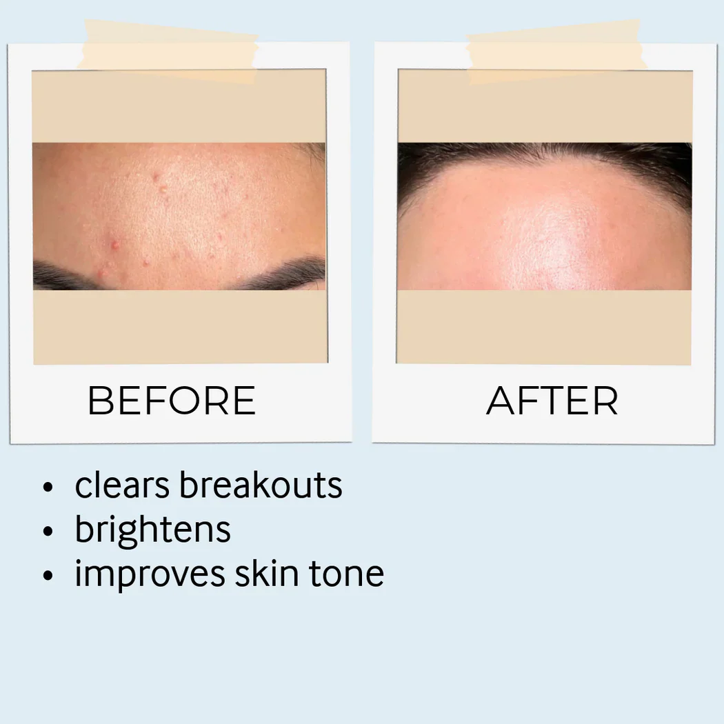 Anti Acne Plan - Image 4